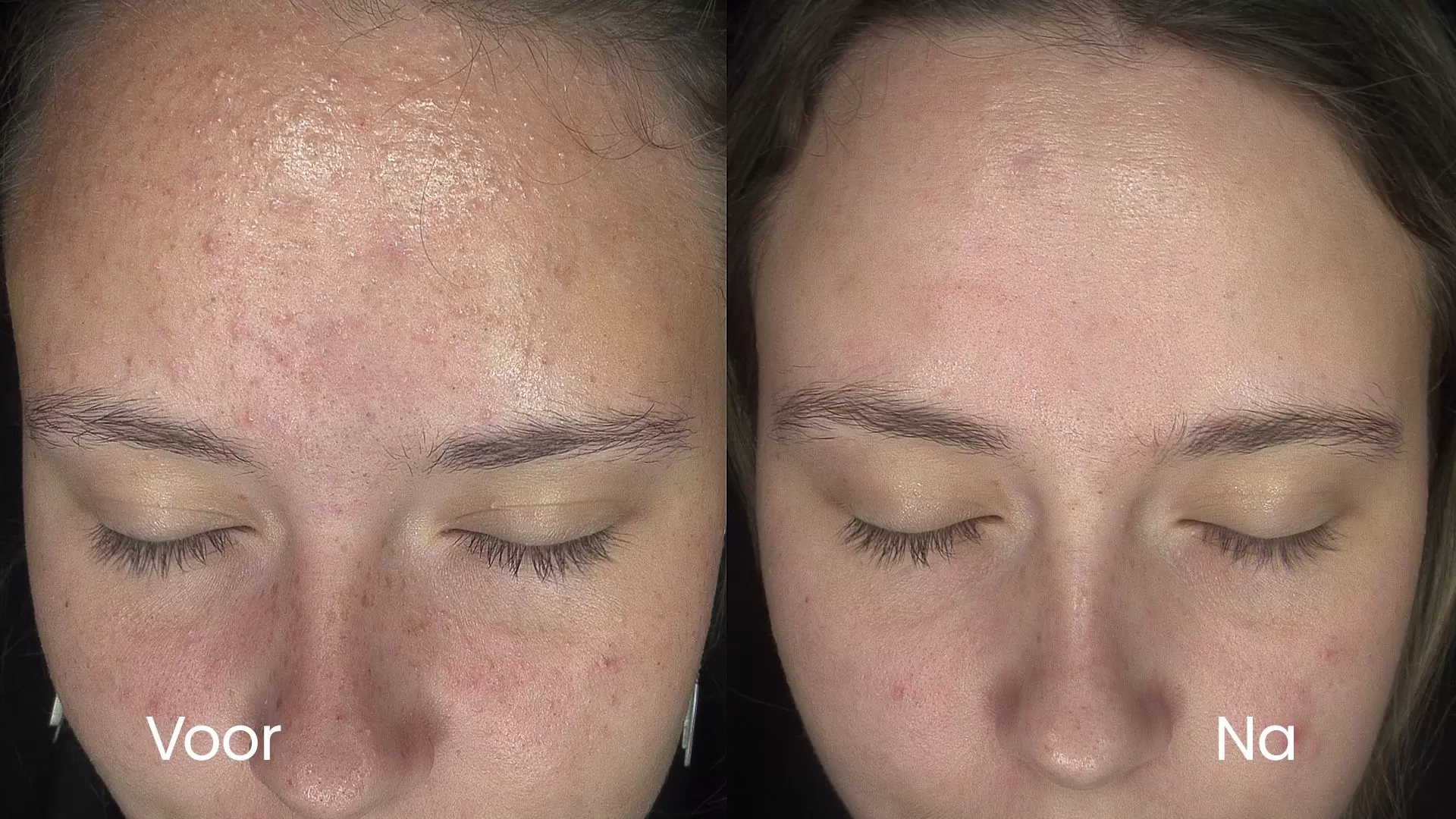 Acne op het voorhoofd voor en na behandeling bij HU!D