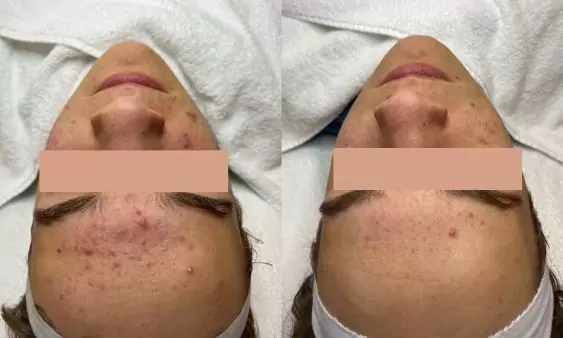 Acne op het voorhoofd voor en na behandeling bij HU!D