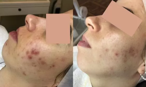 Acne voor en na behandelingen bij HU!D