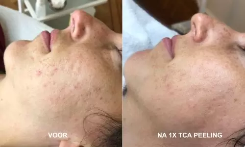 Acne voor en na 1x TCA-peeling bij HU!D
