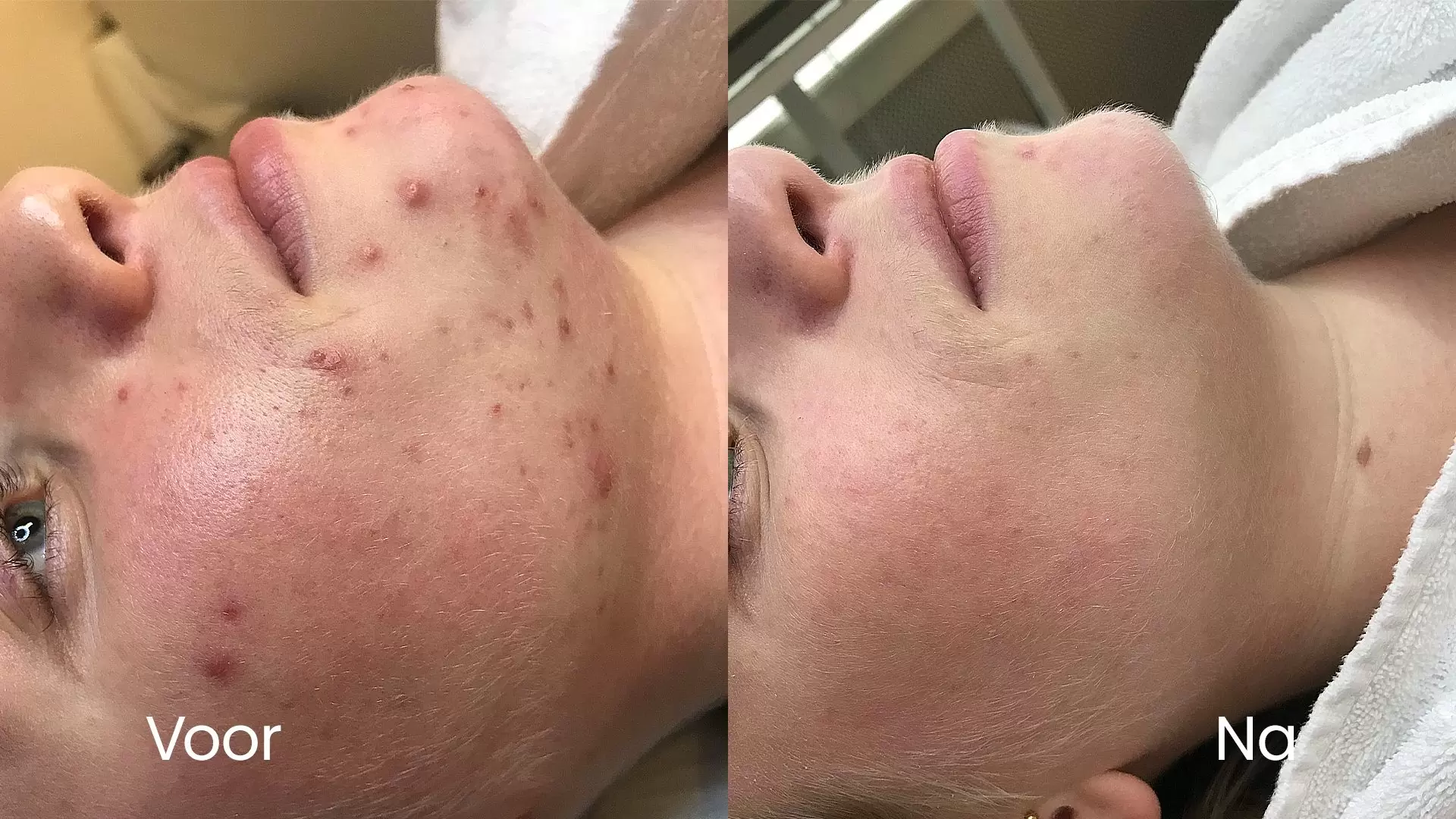 Acne op wang en kin voor en na behandeling bij HU!D