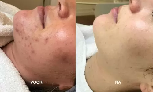 Acne op kin en wang voor en na behandeling bij HU!D