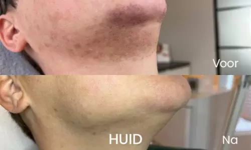 Laserontharing Gezichts- en halshaar — voor & na bij HU!D