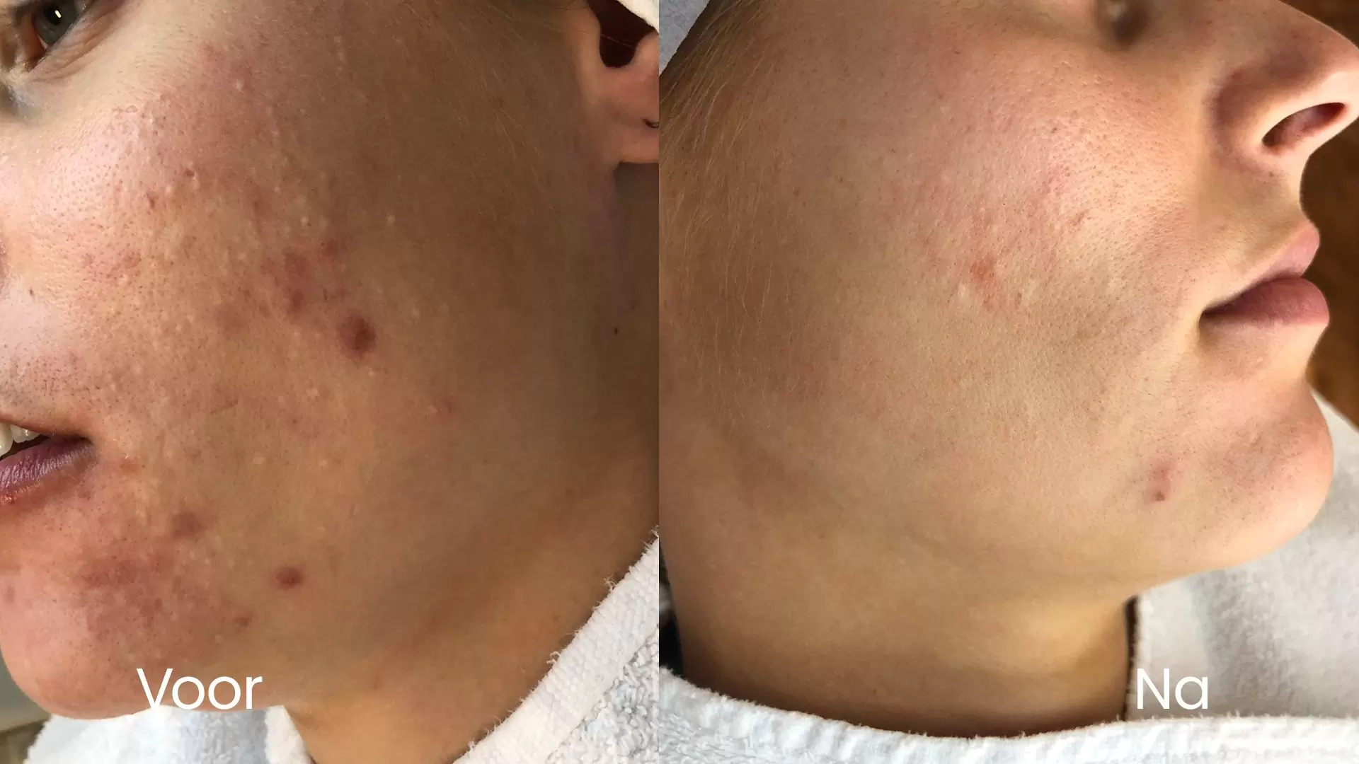 Acne op wang en kin voor en na behandeling bij HU!D