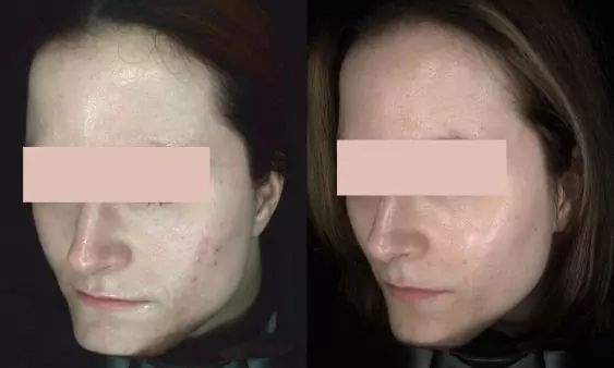 Acne in het gezicht voor en na behandeling bij HU!D