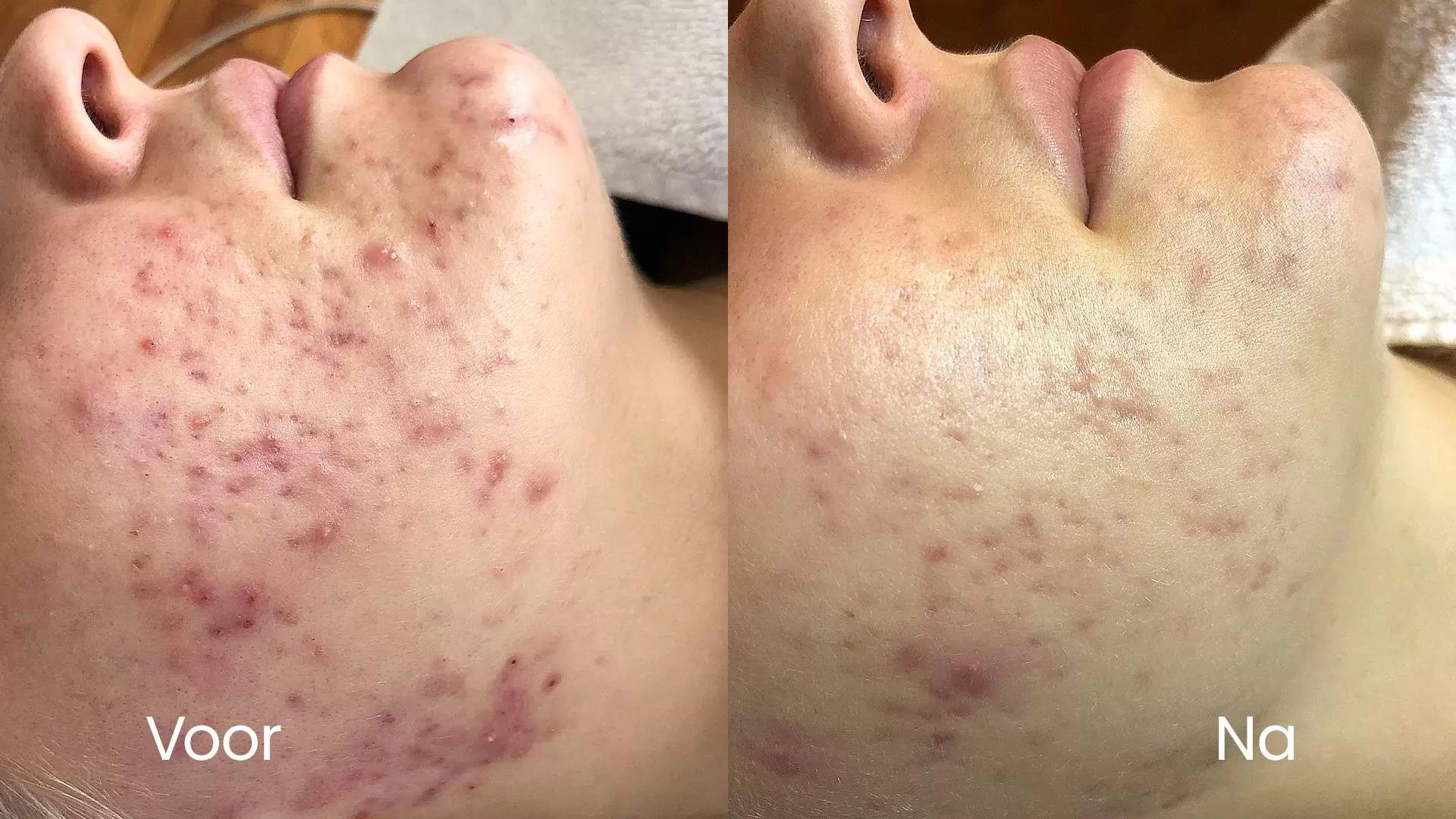 Acne op de kin voor en na behandeling bij HU!D
