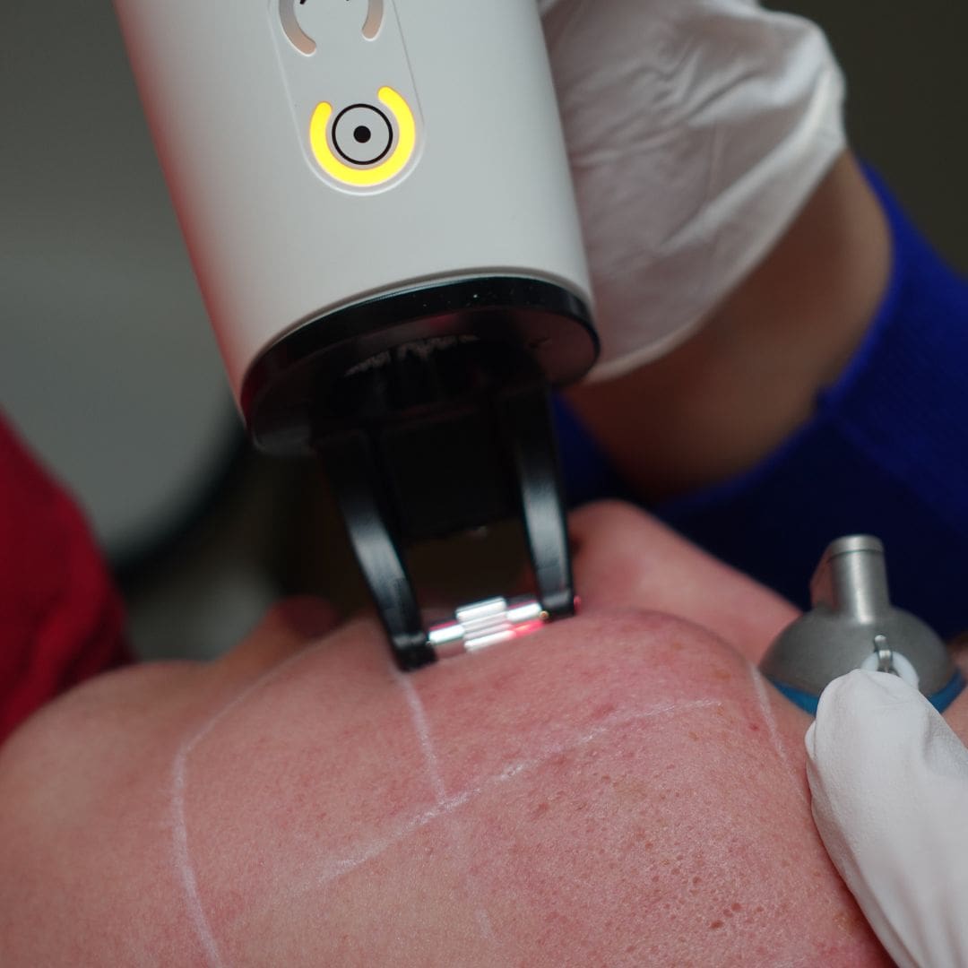 Laserbehandeling (Fractional laser) bij HU!D