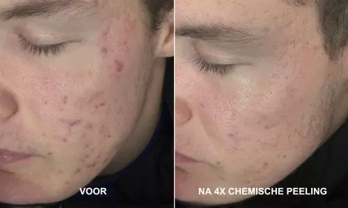 Acne voor en na 4x chemische peeling bij HU!D