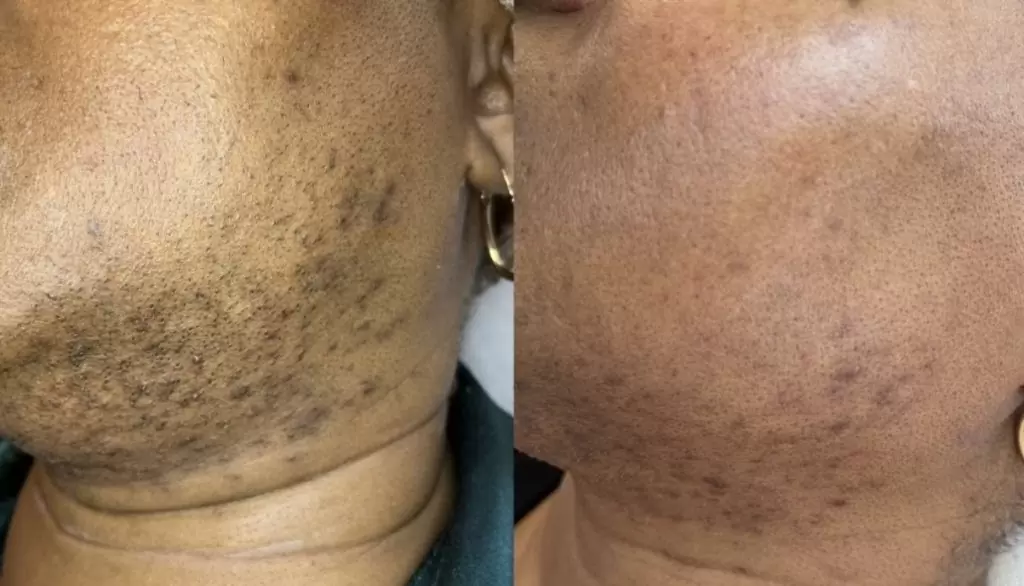 Laserontharing Gezichtshaar — voor & na bij HU!D