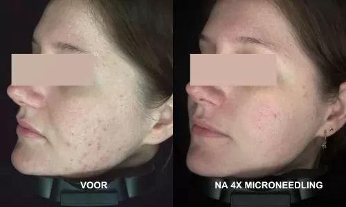 Acne voor en na 4x microneedling bij HU!D