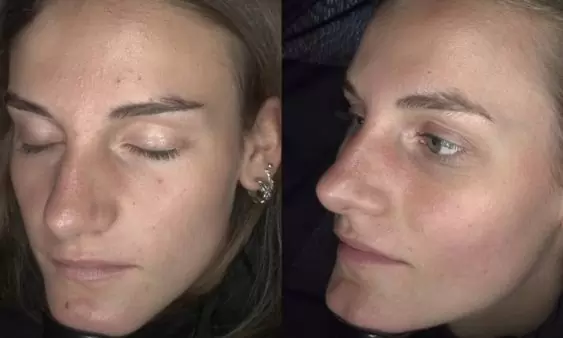 Acne voor en na een acnebehandeltraject bij HU!D
