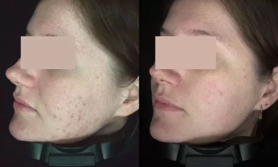 Acne voor en na een behandeltraject bij HU!D
