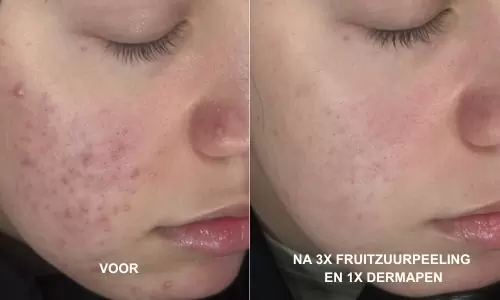 Acne voor en na 3x fruitzuurpeeling en 1x Dermapen bij HU!D